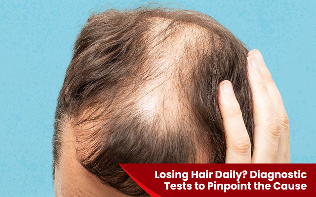 Losing Hair Daily? Diagnostic Tests to Pinpoint the Cause